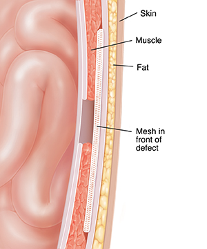 Cross section of abdominal wall showing mesh repair in front of hernia defect.