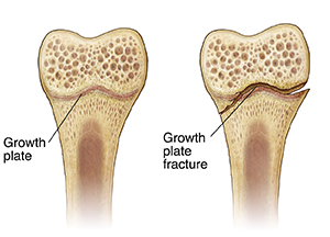 Cross-section of bone showing a growth plate and fractured growth plate