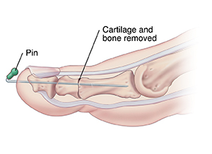 Side view of toe showing fusion and pin fixation.