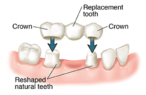 Closeup of bridge being fitted on prepared teeth.