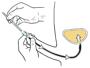 Hands inserting catheter into penis.
