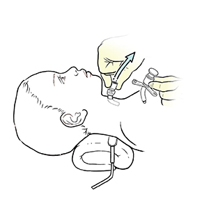 Child lying on back with pillow under neck, gloved hand removing old trach tube from child's neck.