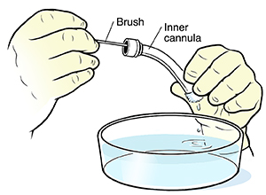 Closeup of pushing cleaning brush through tracheostomy tube over a bowl of water.