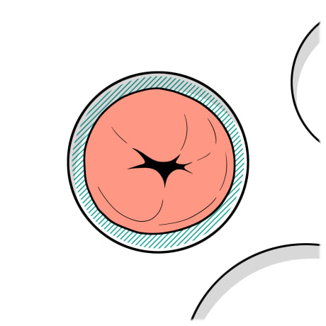 Stoma showing through opening of measuring guide with just enough space around stoma to not touch measuring guide.