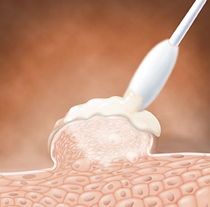 Closeup of skin showing swab applying medication to wart.