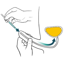 Person holding penis with one hand and inserting catheter tip into tip of penis with other hand, with arrows showing catheter moving toward full bladder.