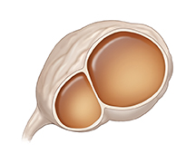 Front view of ovary with benign cystadenoma.