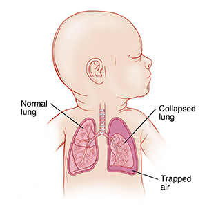 Closeup of baby showing normal lung, collapsed lung, and trapped air.