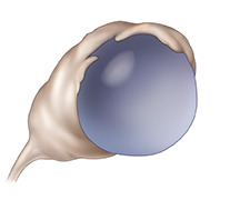Front view of ovary showing ovarian cyst.
