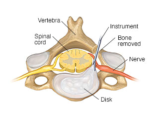 Top view of cervical vertebra and disk with instrument removing disk from the back.