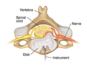 Top view of cervical vertebra and disk with instrument removing disk from front.
