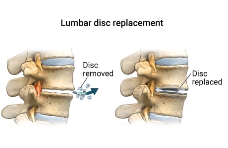 Detailed image of lumbar disc replacement showing disc removed and replaced.