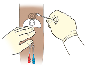 Arm with midline catheter, showing one gloved hand holding catheter against arm while other gloved hand cleans around site with swab in spiral motion moving out from insertion site.