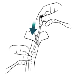 Person holding catheter at funnel with one hand and holding catheter bag with other hand, and arrow showing catheter going back into bag.
