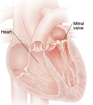 Cross section of heart showing mitral valve prolapse.