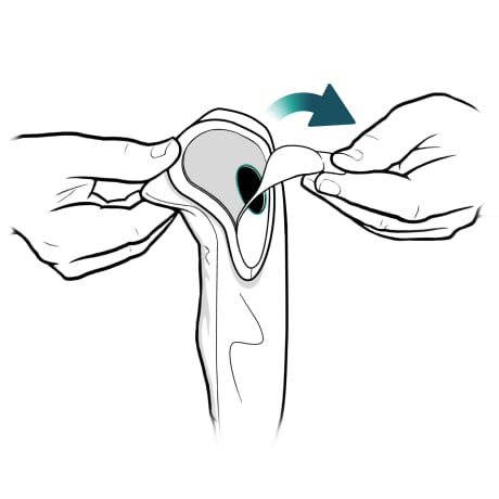 Hand peeling back adhesive layer from front of ostomy bag.