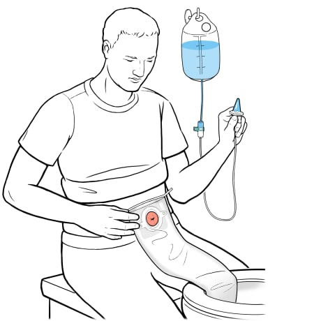 Person sitting next to toilet near hanging water bag with  irrigation sleeve opening in toilet and one hand holding cone.