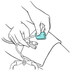 One hand holding catheter and drainage tube and other hand using alcohol wipe to clean leg bag drainage tube tip.
