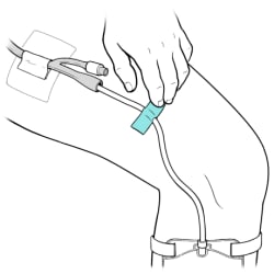 Hand using small pieces of medical tape to attach catheter and leg bag drainage tube to upper leg.