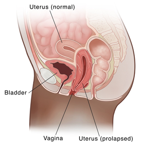 Side view cross section of female pelvis showing a prolapsed uterus.