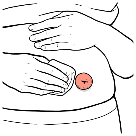 Person holding shirt up with one hand and other hand patting skin around stoma dry with folded cloth.