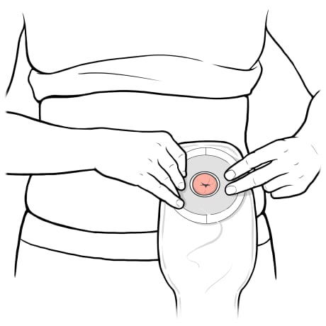 Person putting ostomy bag around stoma.