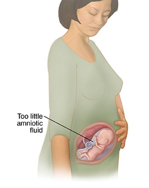 Fetus in womb with too little amniotic fluid.