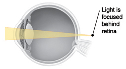 Cross section of eye showing light focusing behind retina.