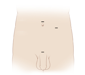 Front view of male outline showing incision sites for laparoscopic varicocelectomy.