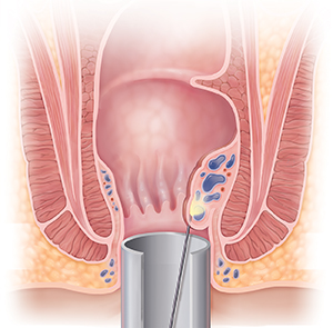 Cross section of anus showing needle releasing medication into hemorrhoid.