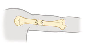 Segmental fracture of  upper arm bone, showing small bone piece floating between two long pieces.