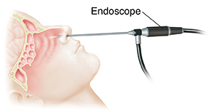 Side view of head showing sinuses and scope inserted into nose.