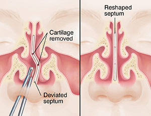 Front view of face showing sinuses and deviated septum repair, before and after.