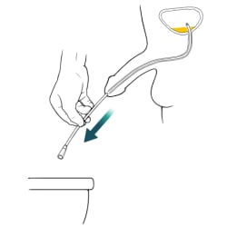 Person pulling catheter, with catheter empty and bladder almost empty.