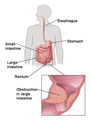 Outline of human figure showing digestive system and pointing out esophagus, small intestine, large intestine, and rectum. Detail of obstruction inside large intestine.
