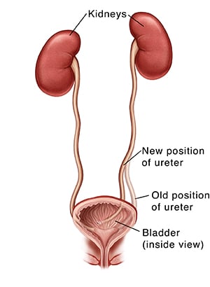 Kidneys, ureters, and bladder, showing old position of ureter and new position after surgery to move ureter to new place in bladder.  