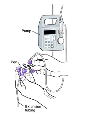 Disconnecting feeding bag tube from port on extension tubing. Feeding bag tube is connected to pump.