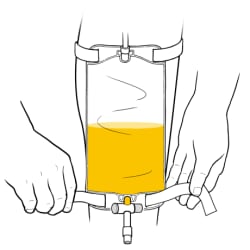 Hands detaching bottom leg strap from leg catheter bag that’s half full of urine.