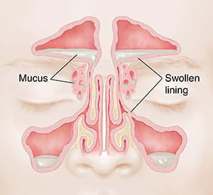 Front view of sinuses showing pale, swollen mucosa and mucus buildup.