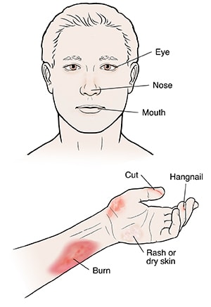 Man's head and arm showing burn, rash, and cut injuries to skin.