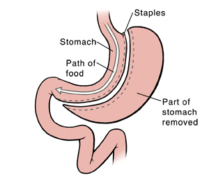 Sleeve gastrectomy showing part of stomach removed and part of stomach left.