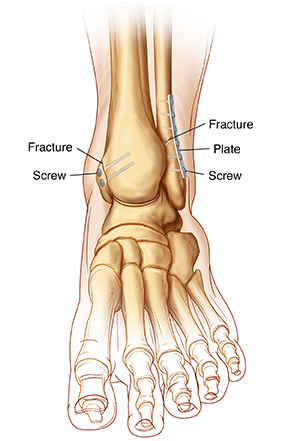 Front view of ankle and foot bones showing ankle fractures with internal fixation.