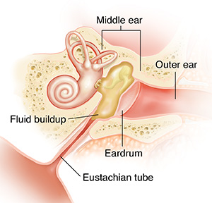Cross section of ear showing fluid in middle ear.