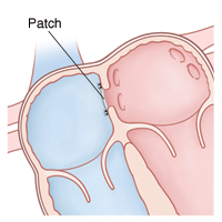 Front view cross section of upper heart showing right and left atria. Patch is in septum between atria.