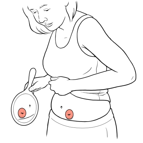 Person holding shirt up with one hand to show stoma on belly and other hand holding mirror to look at stoma.