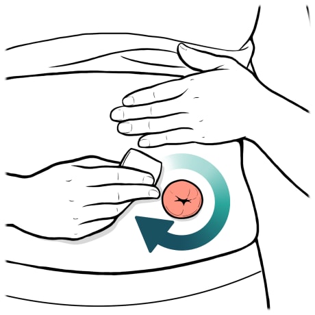 Person using wipe on skin around stoma.