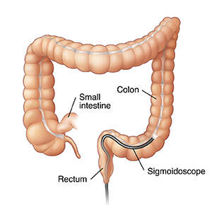 Front view of colon showing scope inserted through anus into sigmoid colon.