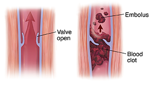 Cross section of muscle and vein showing open valve with arrow showing blood moving up. Cross section of varicose vein with thrombus and emboli.