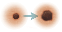 Lesiones en la piel en las que se observa la evolución del cáncer de piel.