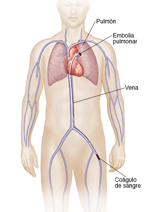 Vista frontal de la figura de un hombre con una flecha que muestra la trayectoria de un coágulo de sangre de la vena de la pierna al pulmón, causando embolia pulmonar.